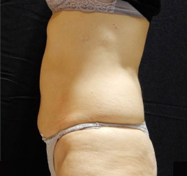 Cellulite comparison 3: after 8 treatments