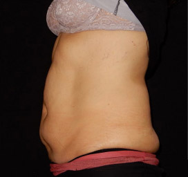 Cellulite comparison 3: before treatment