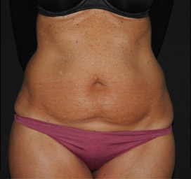 Cellulite comparison 1: after 8 treatments