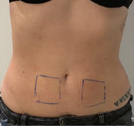 Cellulite comparison 2: after 10 treatments