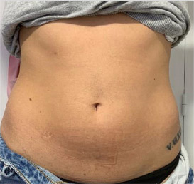 Cellulite comparison 2: before treatment
