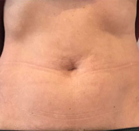Cellulite comparison 4: after 5 treatments