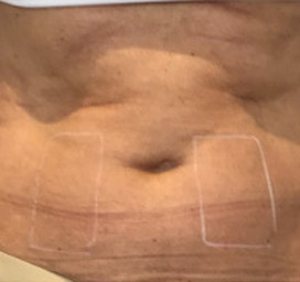 Cellulite comparison 4: before treatment