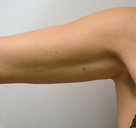 Cellulite comparison 4: after 5 treatments