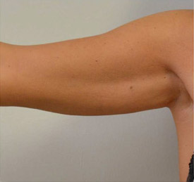 Cellulite comparison 4: before treatment