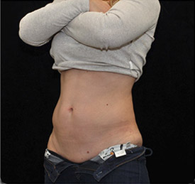 Cellulite comparison 4: after 5 treatments