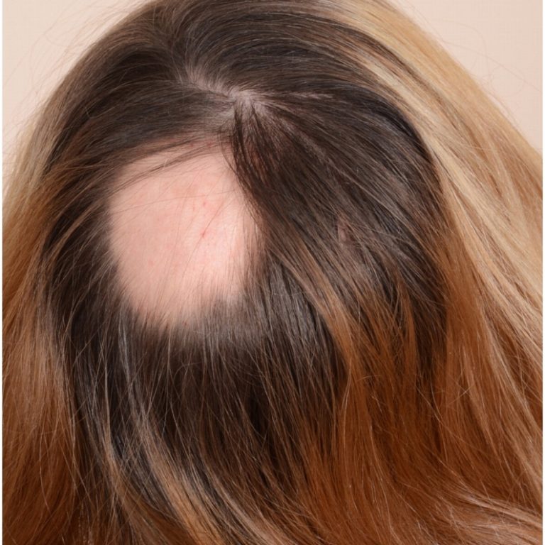 Patchy hair loss